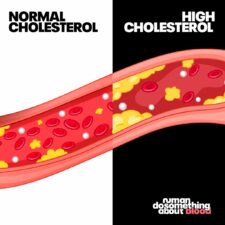 Normal and high cholesterol Normal and high cholesterol